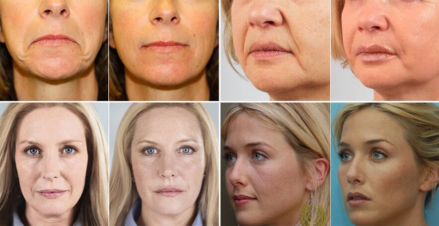 چہرے کی جلد کو جوان کرنے سے پہلے اور بعد میں خواتین کی تصاویر